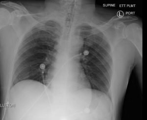 post intubation chest x-ray
