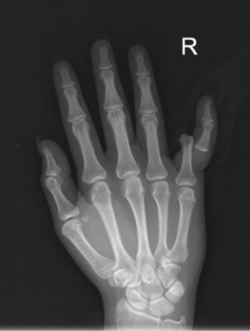 5th Finger Dislocation Xray JETem 2016