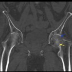 Femoral Neck Fracture 4 Femoral Neck Fracture, AP CT, Annotated. JETem 2016