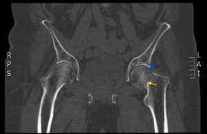 Femoral Neck Fracture, AP CT, Annotated. JETem 2016