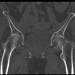 Femoral Neck Fracture 3 Femoral Neck Fracture, AP CT. JETem 2016
