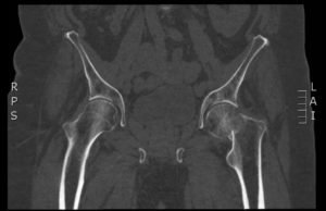 Femoral Neck Fracture, AP CT. JETem 2016