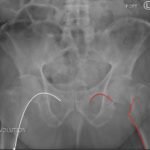 Femoral Neck Fracture 2 Femoral Neck Fracture, AP Xray, Annotated. JETem 2016