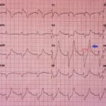 Hyperkalemia ECG, Annotated. JETem 2016