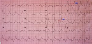 Hyperkalemia ECG, Annotated. JETem 2016