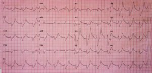 Hyperkalemia ECG JETem 2016