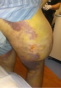 Morel Lavallee Lesion