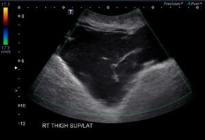 Morel Lavallee Lesion