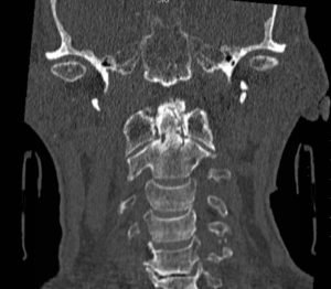 Odontoid Fracture, CT Coronal. JETem 2016