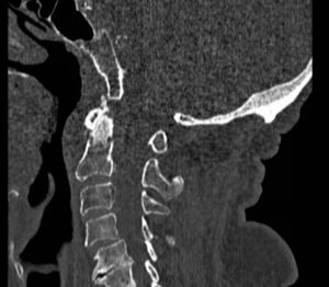 Odontoid Fracture, CT Sagittal. JETem 2016