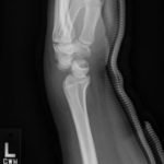 Perilunate Dislocation, XRay. JETem 2016