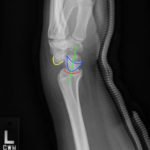 Perilunate Dislocation, Xray, Annotated. JETem 2016
