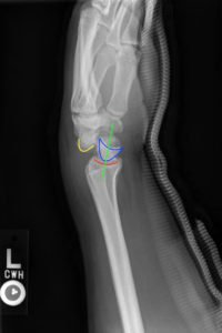 Perilunate Dislocation, Xray, Annotated. JETem 2016