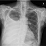 Large Right Pleural Effusion 2 Pleural Effusion, AP Chest Xray JETem 2016