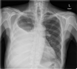 Pleural Effusion, AP Chest Xray JETem 2016