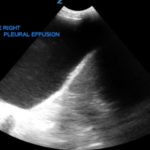 Large Right Pleural Effusion 1 Large Right Pleural Effusion