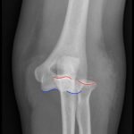 Posterior Elbow Dislocation 1 Creative Commons images
