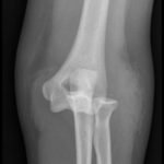 Posterior Elbow Dislocation 7 Posterior Elbow Dislocation, AP XRay, dislocated. JETem 2016