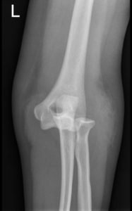 Posterior Elbow Dislocation, AP XRay, dislocated. JETem 2016