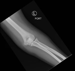 Posterior Elbow Dislocation, AP XRay, reduced. JETem 2016