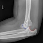 Posterior Elbow Dislocation 3 Creative Commons images