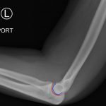 Posterior Elbow Dislocation 4 Creative Commons images