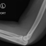 Posterior Elbow Dislocation 10 Posterior Elbow Dislocation, Lateral XRay, reduced. JETem 2016