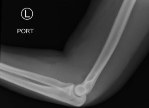Posterior Elbow Dislocation, Lateral XRay, reduced. JETem 2016