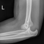 Posterior Elbow Dislocation 9 Posterior Elbow Dislocation, Lateral Xray, dislocated. JETem 2016