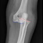 Posterior Elbow Dislocation 5 Creative Commons images