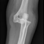Posterior Elbow Dislocation 6 Posterior Elbow Dislocation, Oblique XRay, dislocated. JETem 2016