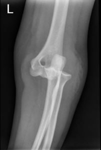 Posterior Elbow Dislocation, Oblique XRay, dislocated. JETem 2016
