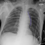 Traumatic Aortic Injury. AP Chest XRay, Annotated. JETem 2016