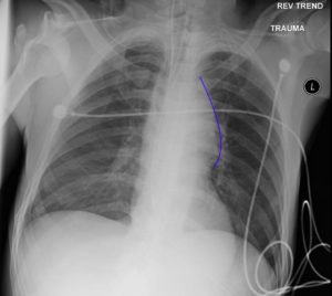 Traumatic Aortic Injury. AP Chest XRay, Annotated. JETem 2016