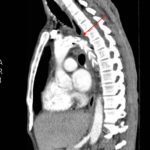 Traumatic Aortic Injury. Sag CT 1, Annotated. JETem 2016