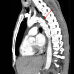 Traumatic Aortic Injury. Sag CT 2 Annotated. JETem 2016