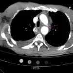 Traumatic Aortic Injury. Trans CT 1, Annotated. JETem 2016