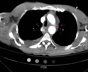 Traumatic Aortic Injury. Trans CT 1, Annotated. JETem 2016