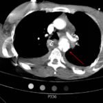 Traumatic Aortic Injury. Trans CT 2, Annotated. JETem 2016