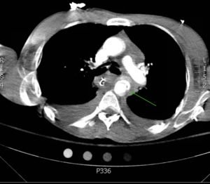 Traumatic Aortic Injury. Trans CT 3, Annotated. JETem 2016