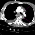 Traumatic Aortic Injury. Trans CT 4, Annotated. JETem 2016