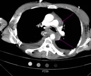 Traumatic Aortic Injury. Trans CT 4, Annotated. JETem 2016