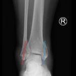 Trimalleolar Fracture, AP XRay, Annotated. JETem 2016