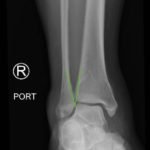 Trimalleolar Fracture, Oblique XRay, Annotated. JETem 2016