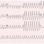 Wolff-Parkinson-White Syndrome: Electrocardiogram 1 WPW EKG 1, initial EKG. JETem 2016