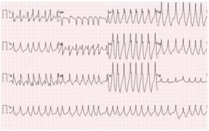 WPW EKG 1, initial EKG. JETem 2016