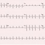 Wolff-Parkinson-White Syndrome: Electrocardiogram 3 Creative Commons images