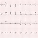 Wolff-Parkinson-White Syndrome: Electrocardiogram 2 WPW EKG 3, after procainamide infusion. JETem 2016