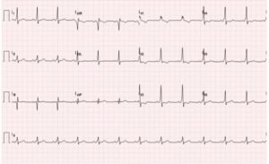 WPW EKG 3, after procainamide infusion. JETem 2016