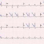 Wolff-Parkinson-White Syndrome: Electrocardiogram 4 Creative Commons images